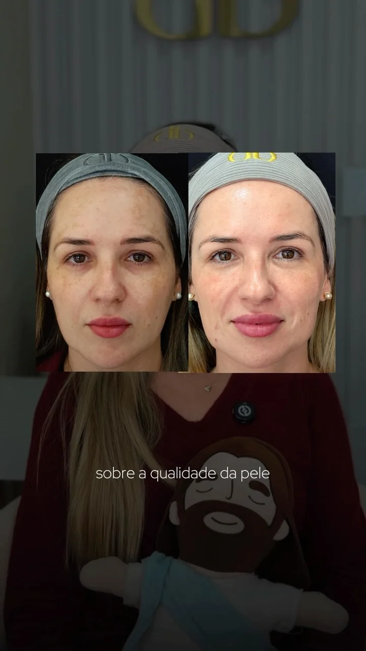 Post do Instagram da Dra. Barbara Postal com resultado de pele