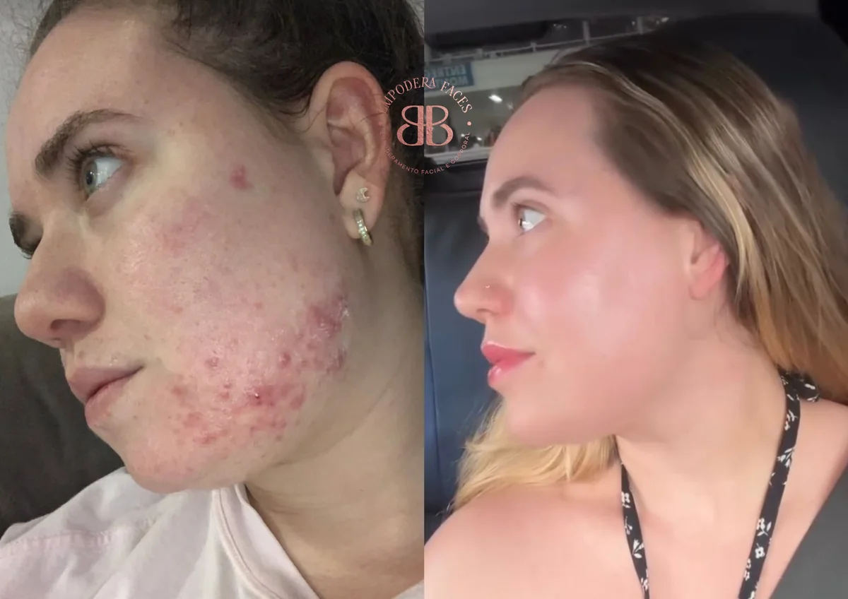 Antes e depois de tratamento facial com melhora de acne e qualidade de pele