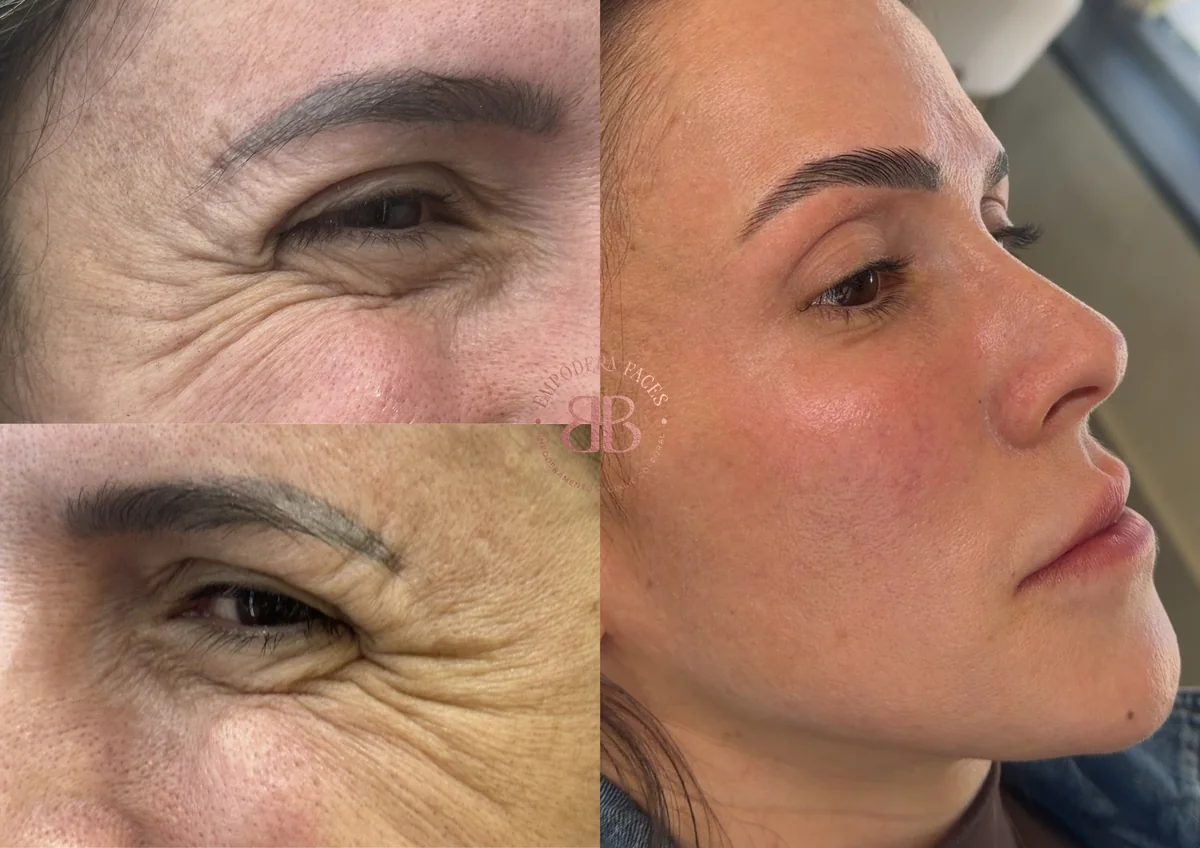 Antes e depois de tratamento facial com melhora de textura na região dos olhos