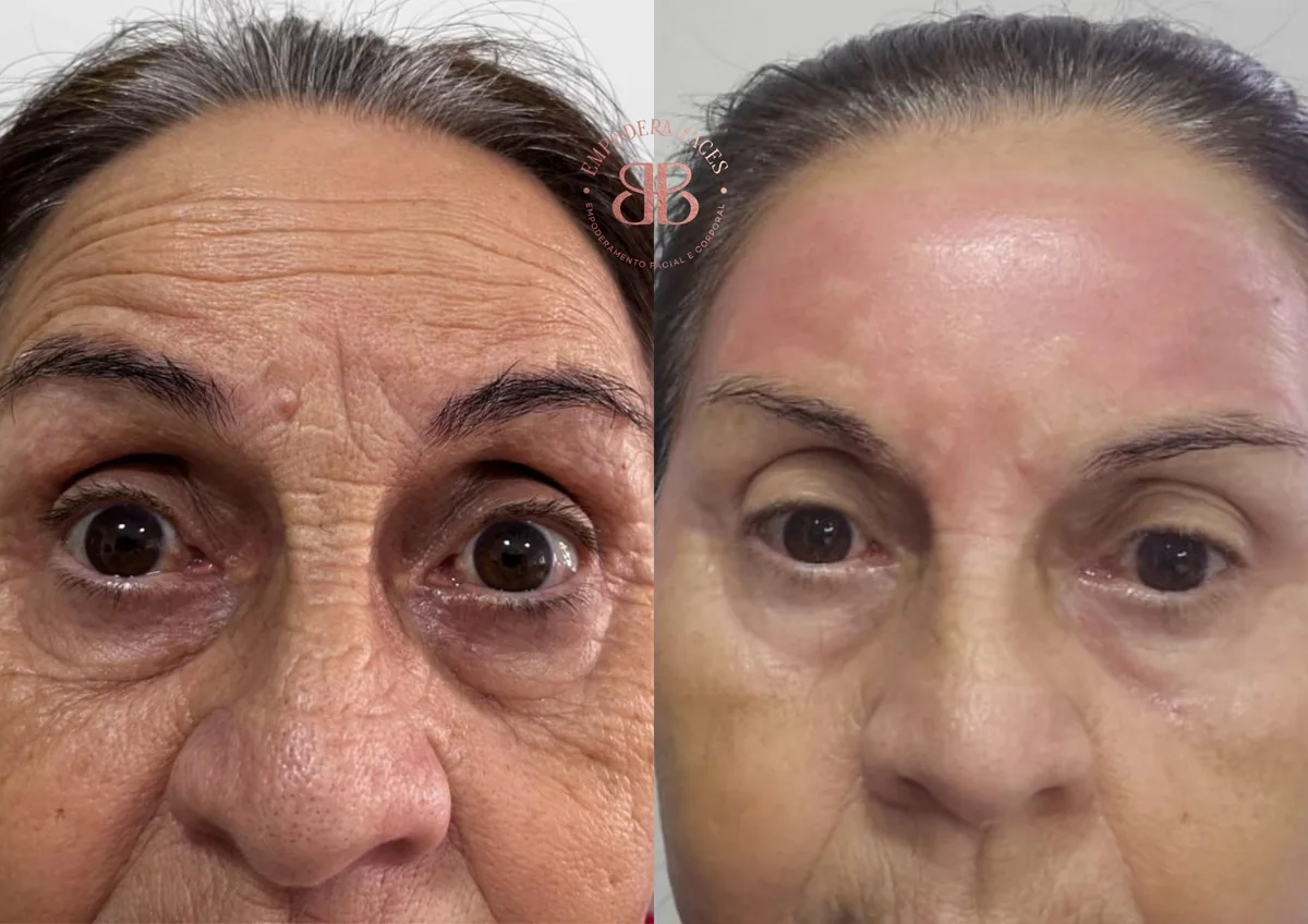 Antes e depois de tratamento facial com melhora de rugas e textura