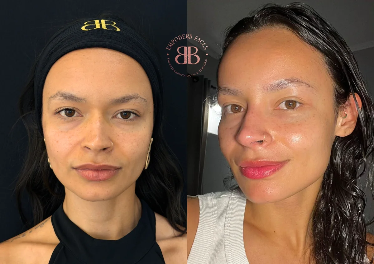Antes e depois de tratamento facial com mais viço e naturalidade