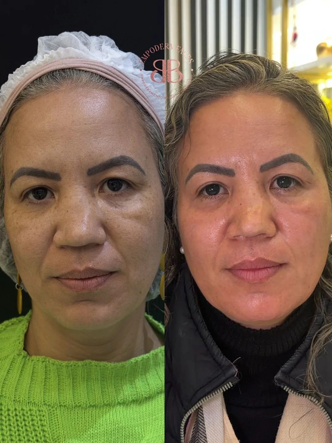 Antes e depois de tratamento facial com melhora global da pele